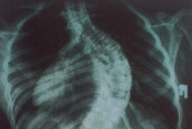 Zdjęcie RTG skrzywionego kręgosłupa