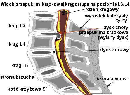 Widok przepukliny krążkowej kręgosłupa na poziomie L3/L4